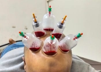 Massage Therapy Cupping Delhi, Hijama Treatment Center Delhi