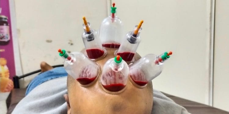 Massage Therapy Cupping Delhi, Hijama Treatment Center Delhi